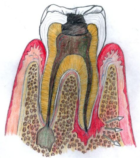 Periodontitt, apikal Periodontitt, apikal