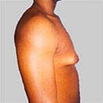 Gynekomasti Gynekomasti