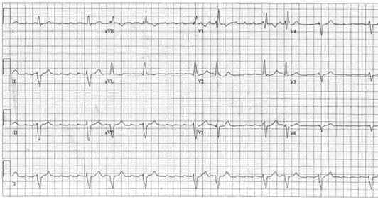 atrieflutter 2 atrieflutter 2