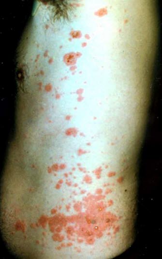 Utslett med blemmer av varierende størrelse på erythematøs hud.