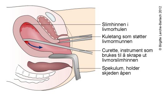 Abrasio (utskraping) Abrasio (utskraping)