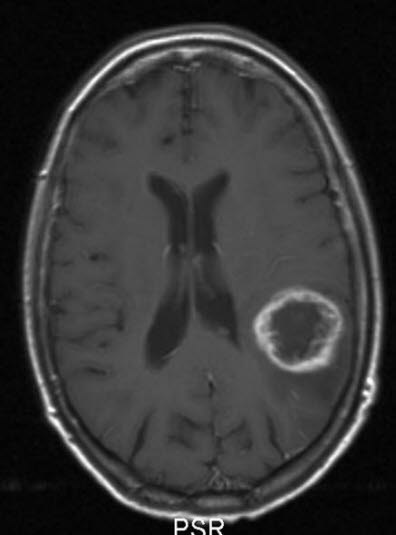 glioblastom who grad iv 2 glioblastom who grad iv 2