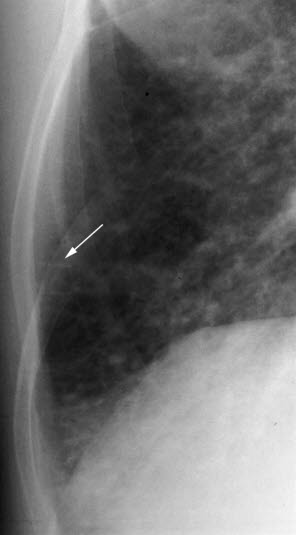 Hjertesvikt, lett-2 Hjertesvikt, lett-2
