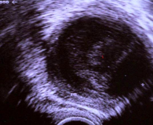 Tubo-ovariell abscess