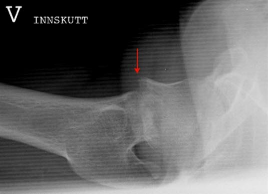 Collum femoris fraktur, innskutt