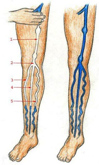 Trendelenburgs test ved åreknuter Trendelenburgs test ved åreknuter