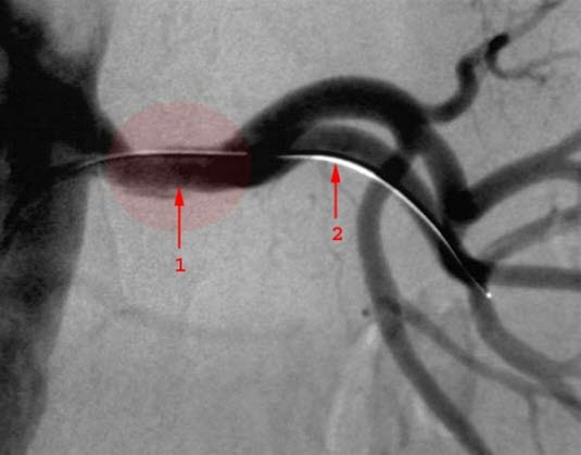 Nyrearteriestenose behandlet