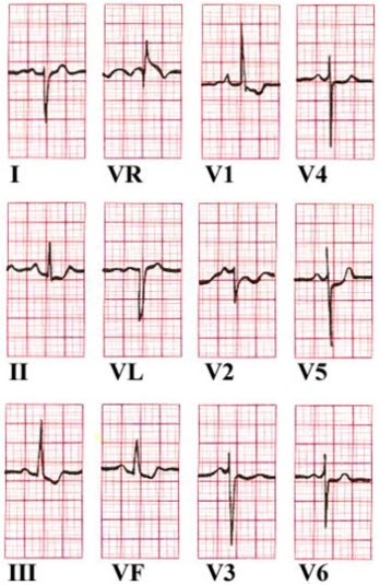 Høyre ventrikkelhypertrofi (12) Høyre ventrikkelhypertrofi (12)