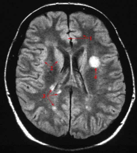 Forandringer i hjernen ved MS - ødeleggelse av myelinet. Forandringer i hjernen ved MS - ødeleggelse av myelinet.