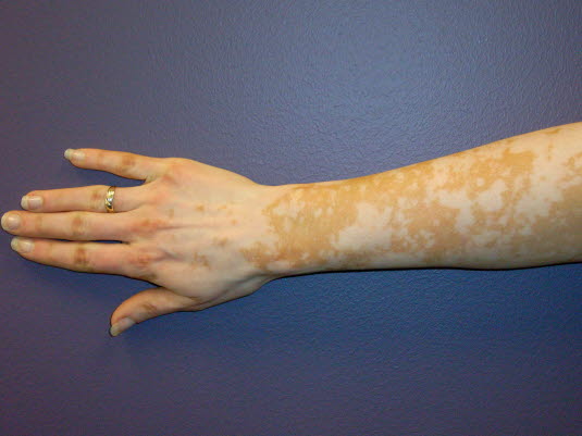 Vitiligo