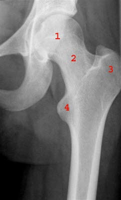 Røntgenbilde av normalt hofteledd. Røntgenbilde av normalt hofteledd.