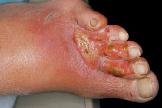 Arterielt fotsår Arterielt fotsår