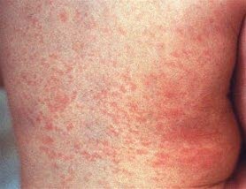 Røde hunder Røde hunder