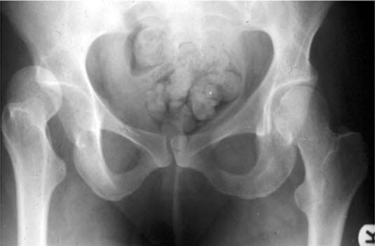 hofteleddslukasjon, traumatisk