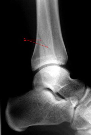 Malleolfraktur, side