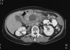 Pseudocyste i bukspyttkjertelen