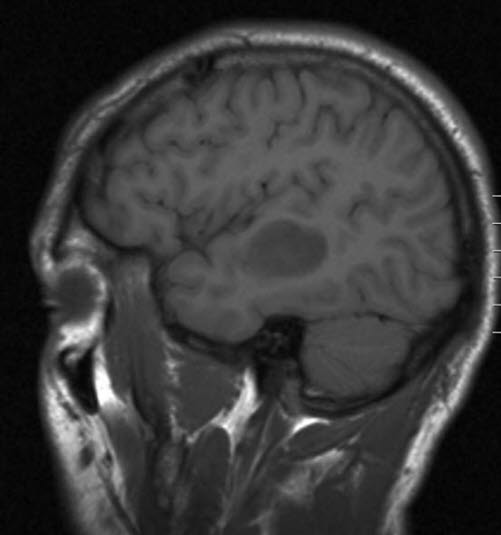 lavgradig astrocytom who grad ii 2 lavgradig astrocytom who grad ii 2