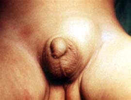 Inguinalhernie 2 Inguinalhernie 2