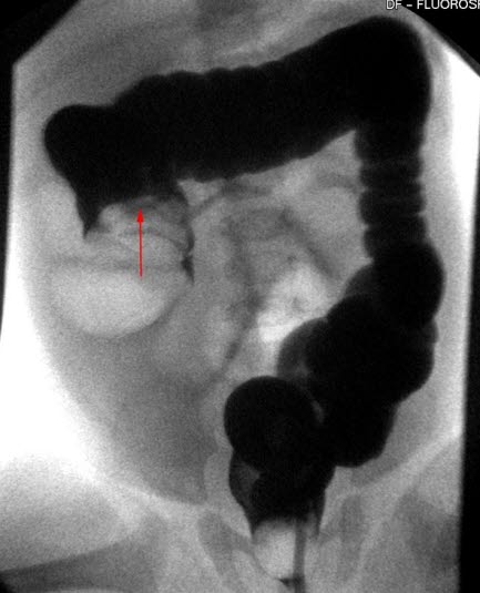 Colon-invaginasjon Colon-invaginasjon