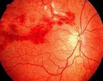 Hypertensiv retinopati.jpg Hypertensiv retinopati.jpg