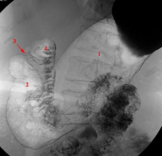 Ventrikkel normal, liggende Ventrikkel normal, liggende