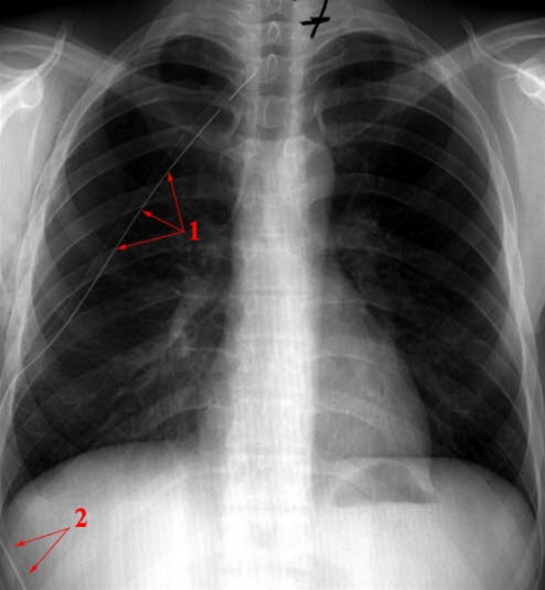 Ventilpneumothorax - behandlet