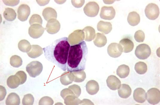 Mononukleose, McKinlay celler