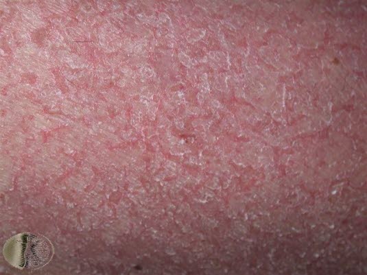 Eksema craquelé (asteatotisk dermatitt - svært tørr hud)