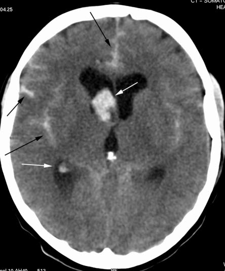 Subaraknoidalblødning (CT) Subaraknoidalblødning (CT)