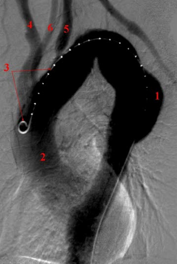 Aortaaneurisme, thoracalt