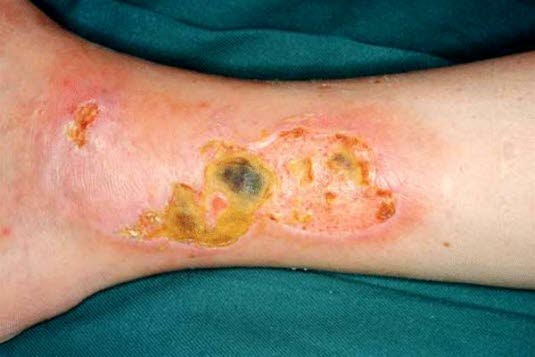Venøst leggsår, tørt
