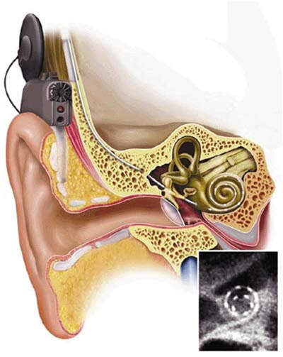 Cochlea implantat
