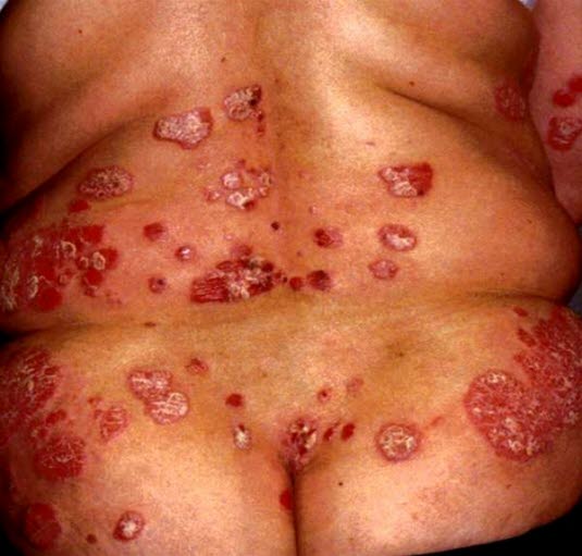 Uttalt psoriasis