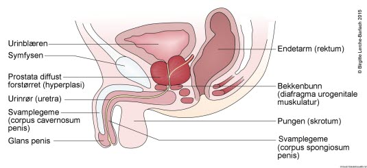 Prostata - hypertrofi Prostata - hypertrofi