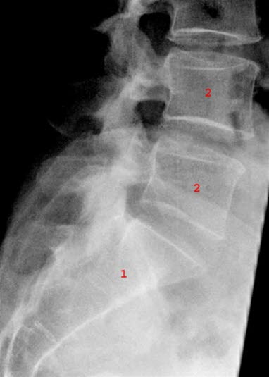 Halebeinet er nedre ende av ryggsøylen
