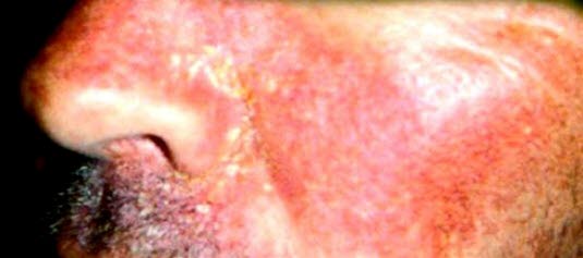 Eksem ved nesevingene, i nasolabialfuren, langs øyenvippene, i øyenbrynene, i hårbunnen og langs hårfeste, i øregangene og bak ørene, presternalt og interskapulært er typisk hos unge og voksne.