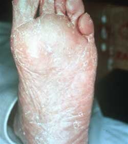 Fotsopp av mokkasintype viser seg som langvarig, ikke-inflammatorisk skalling av huden i fotsålen, under hælen og ev. oppover sidene av foten.