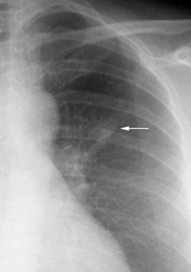 Lungecancer (rtg) Lungecancer (rtg)