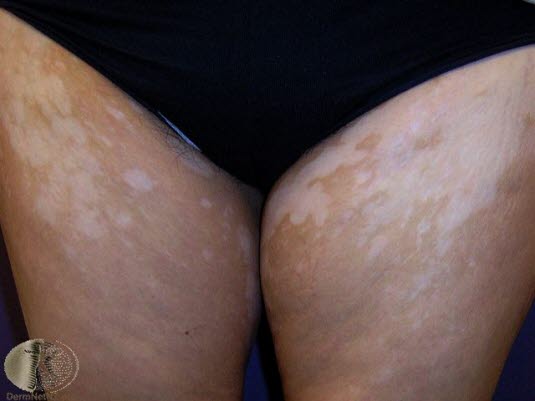 Vitiligo 2