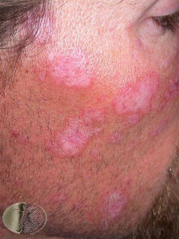 Diskoid lupus erythematosus, ansikt 2