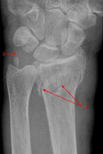 Håndleddsbrudd sett forfra Håndleddsbrudd sett forfra
