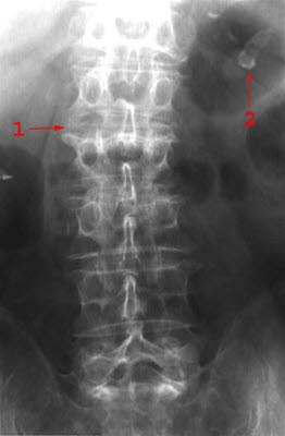 Columnafraktur frontalbilde Columnafraktur frontalbilde