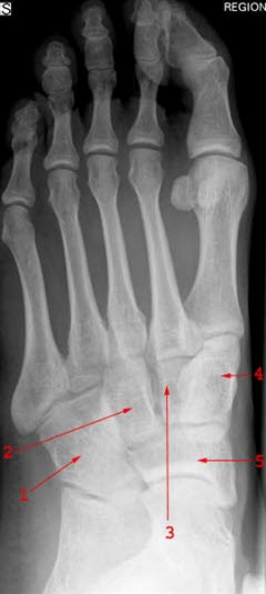 Røntgen av normal fot Røntgen av normal fot