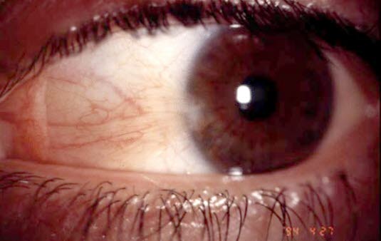 Pterygium