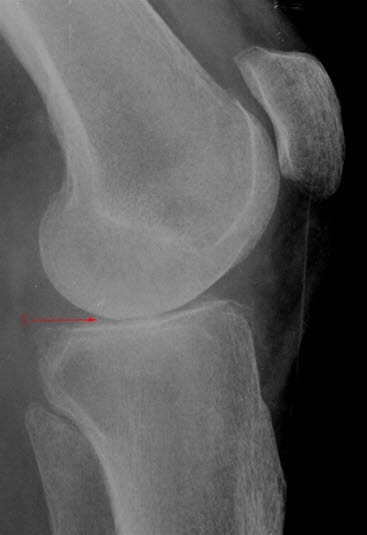 Gonartrose, moderat, side