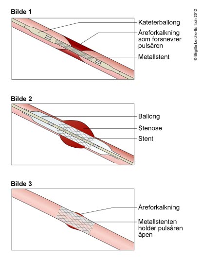 Utblokking og stenting Utblokking og stenting
