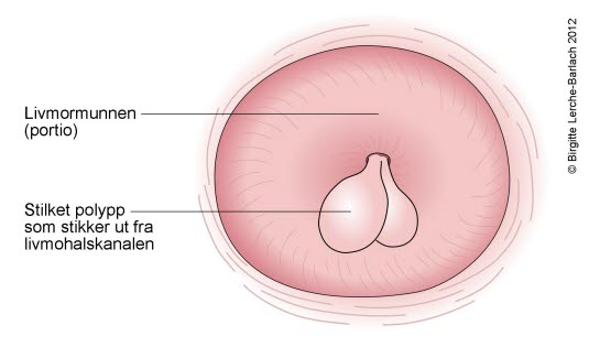 Polypper i livmorhalsen Polypper i livmorhalsen