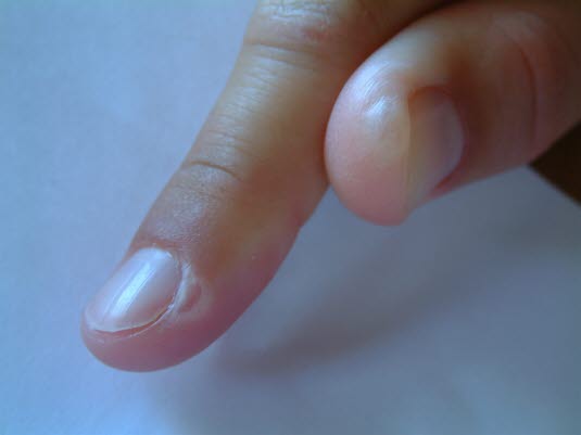 Blemmer på fingrene.