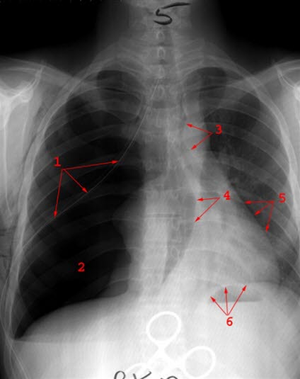 Ventilpneumothorax