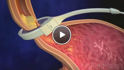 Laparoskopisk gastrisk banding